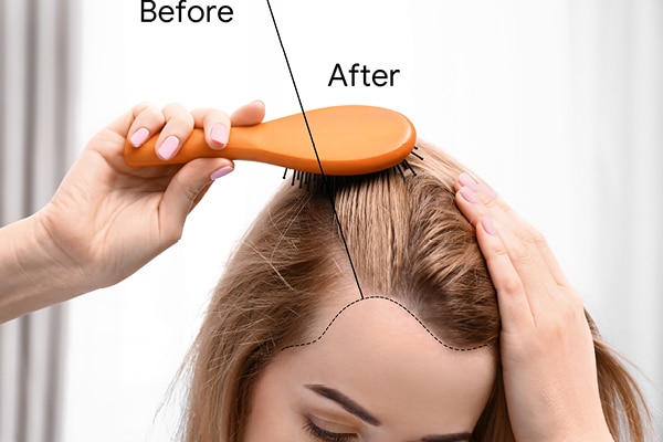 Walnut oil benefits 12: Helps reduce migraine attacks Walnut oil benefits 12: Helps reduce migraine attacks