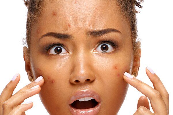 How to treat fungal face acne? How to treat fungal face acne?
